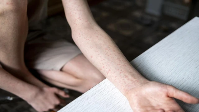 ABD'de kızamık vakaları artıyor